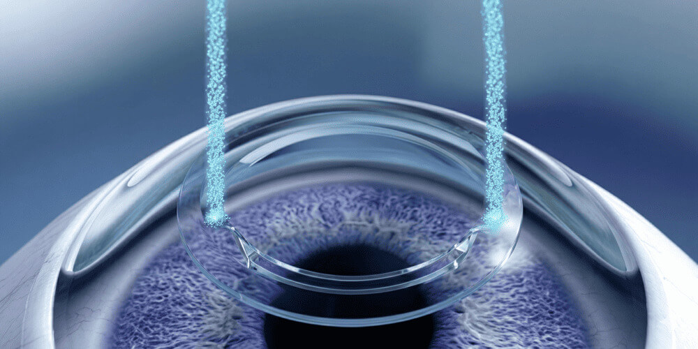 Chirurgie réfractive PKR et FemtoLASIK